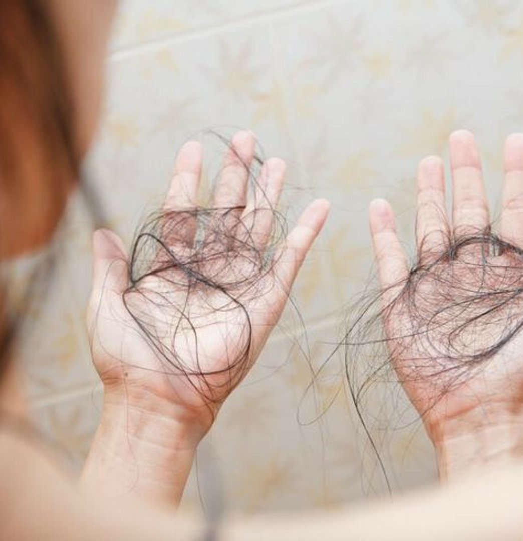 Woman holding hair lost to thinning and shedding