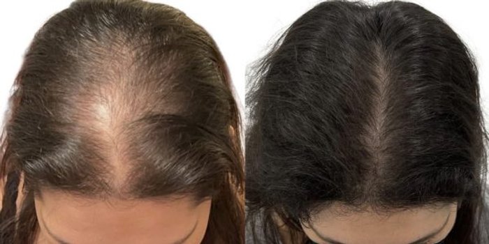 Before and after hair restoration on a woman's thinning part line