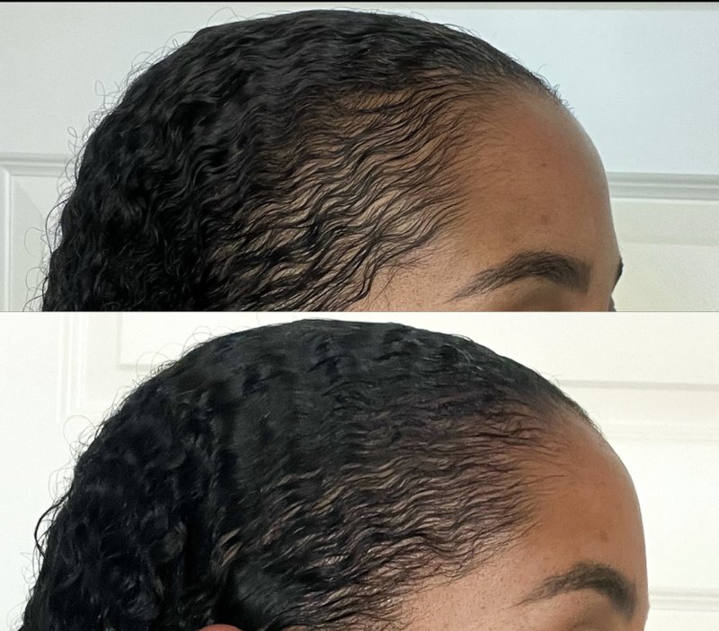 Before and after hair restoration along a Black woman's hairline and edges