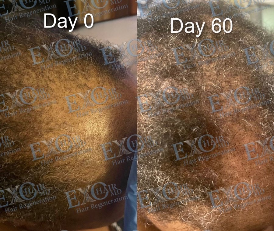Before and after exosome hair therapy showing restored crown density at day 60