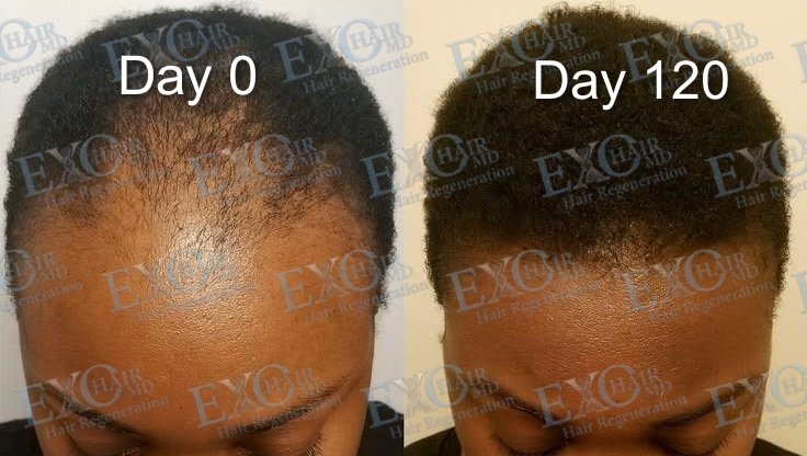 Before and after exosome hair restoration on a thinning crown at day 120
