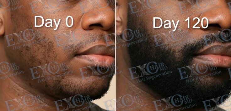 Before and after exosome therapy thickening a patchy beard at day 120