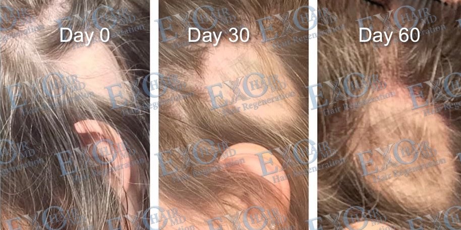 Progressive before and after exosome hair therapy results at day 0, day 30 and day 60