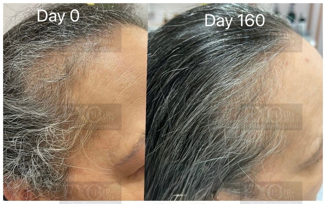 Before and after exosome therapy thickening a thinning grey hairline at day 160