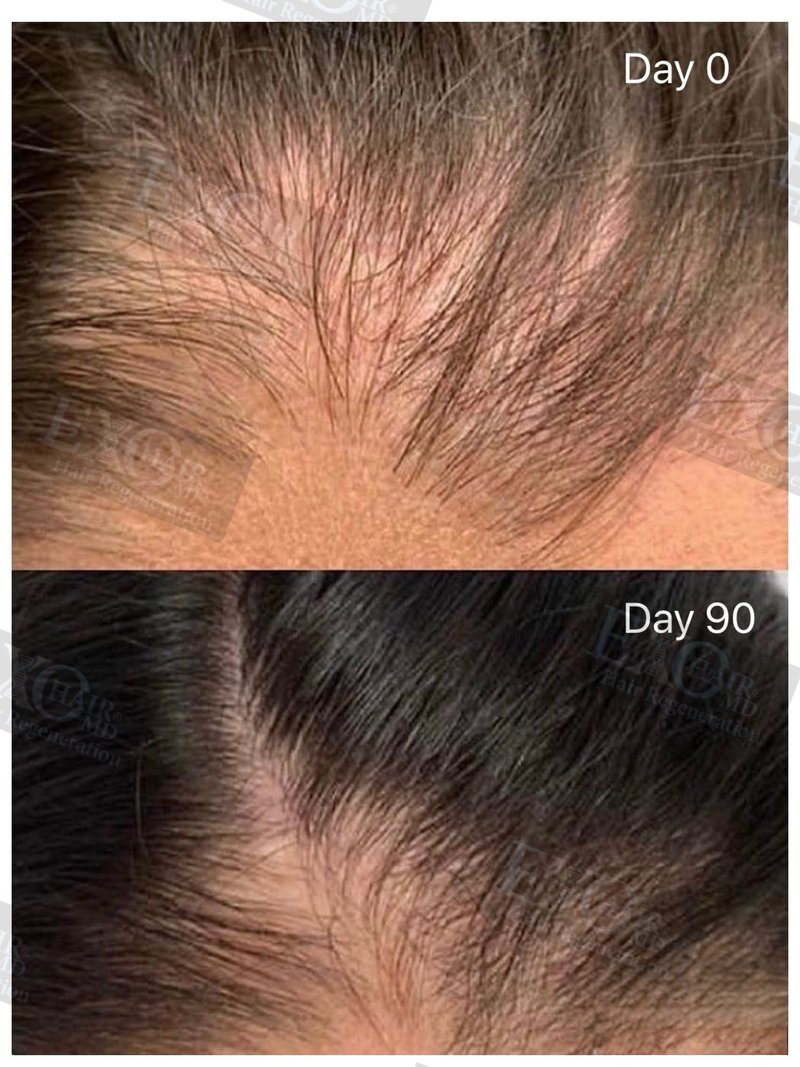 Before and after exosome therapy filling in a widening part line at day 90