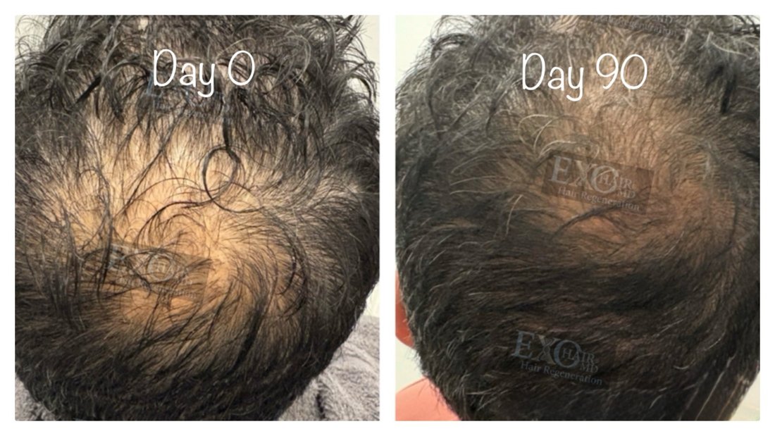 Before and after exosome hair restoration filling in a bald spot at the crown by day 90
