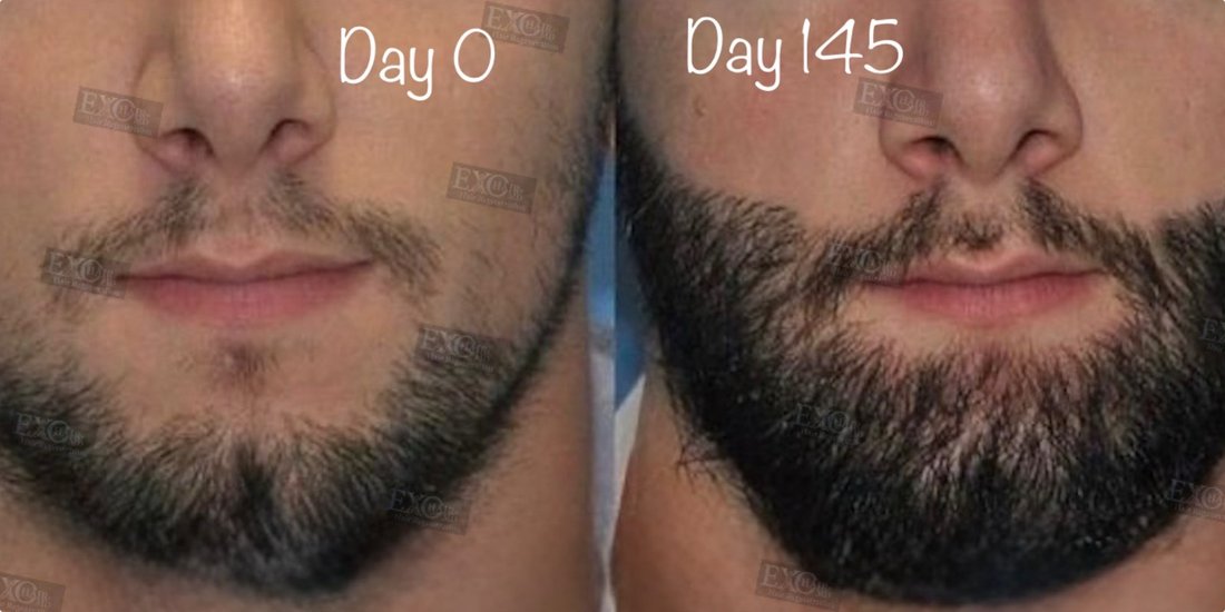 Before and after exosome therapy filling in beard density at day 145