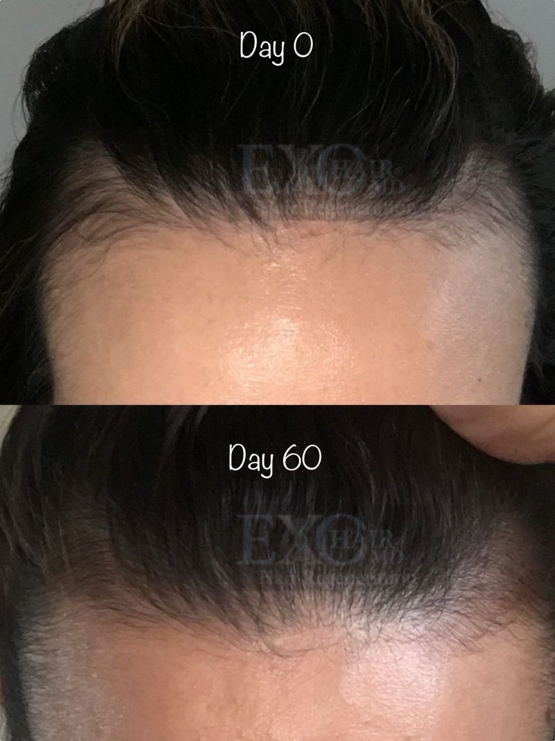 Before and after exosome therapy restoring a receding frontal hairline at day 60