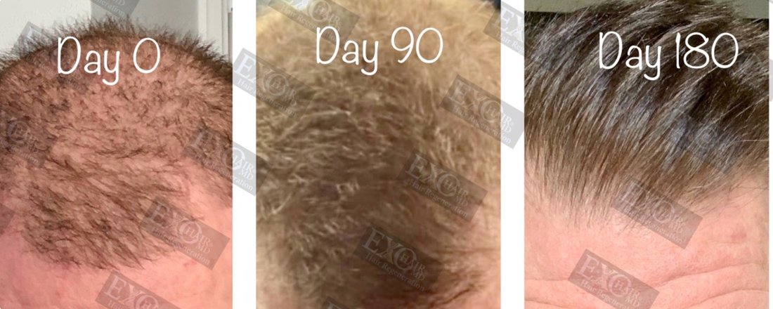Progressive before and after male crown regrowth at day 0, day 90 and day 180