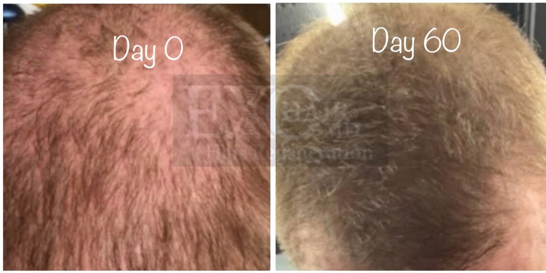 Before and after exosome therapy adding density to a man's thinning crown at day 60