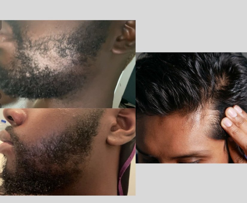 Before and after results for men’s hair and beard restoration