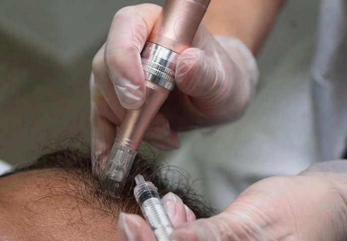 Provider performing a microneedling scalp treatment with exosomes
